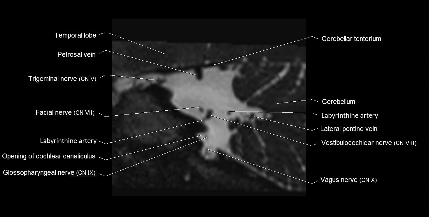 Internal auditory meatus (IAM) 3T sagittal cross sectional anatomy image 29.webp
